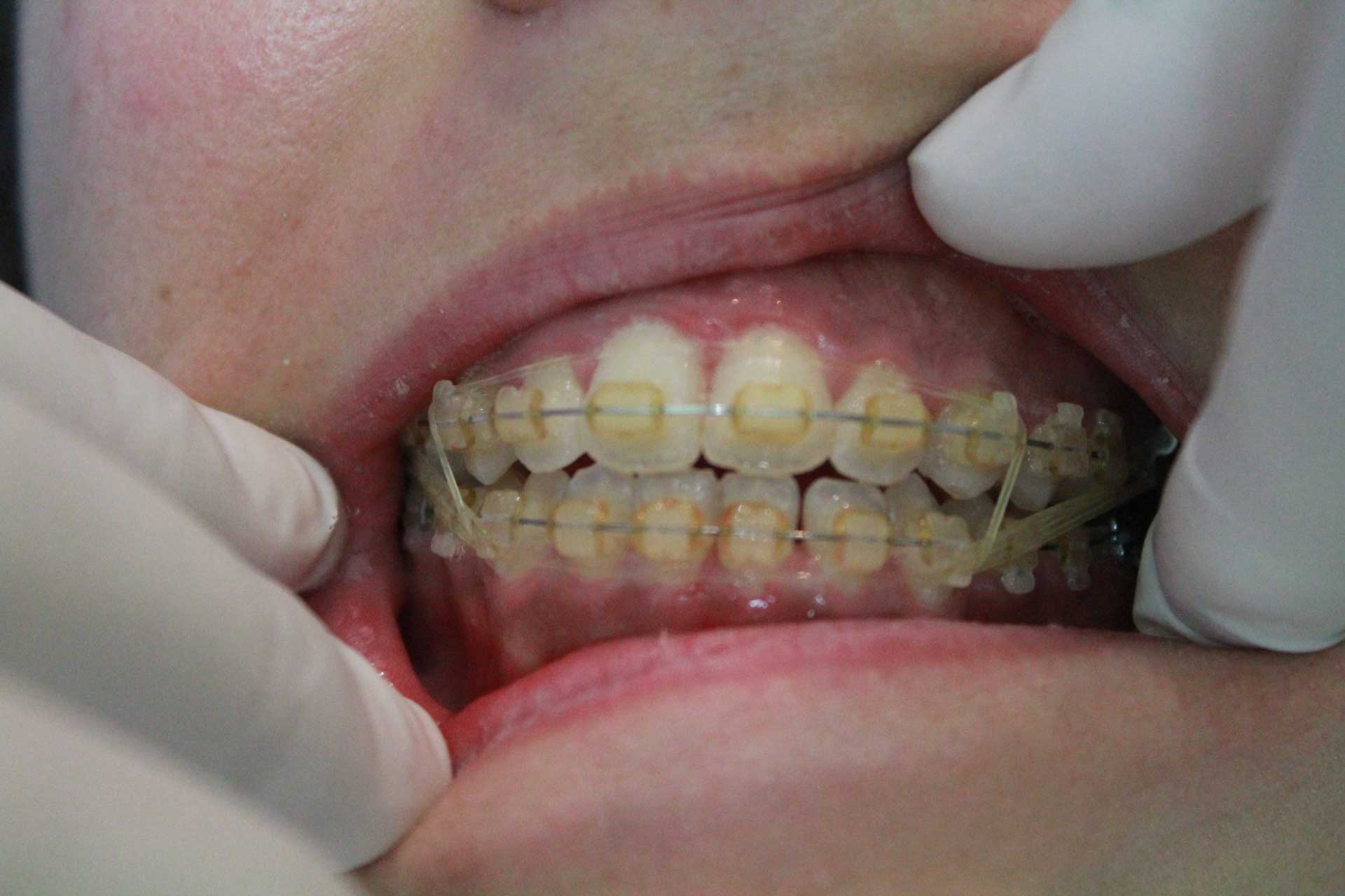 Ortodonzia adulto