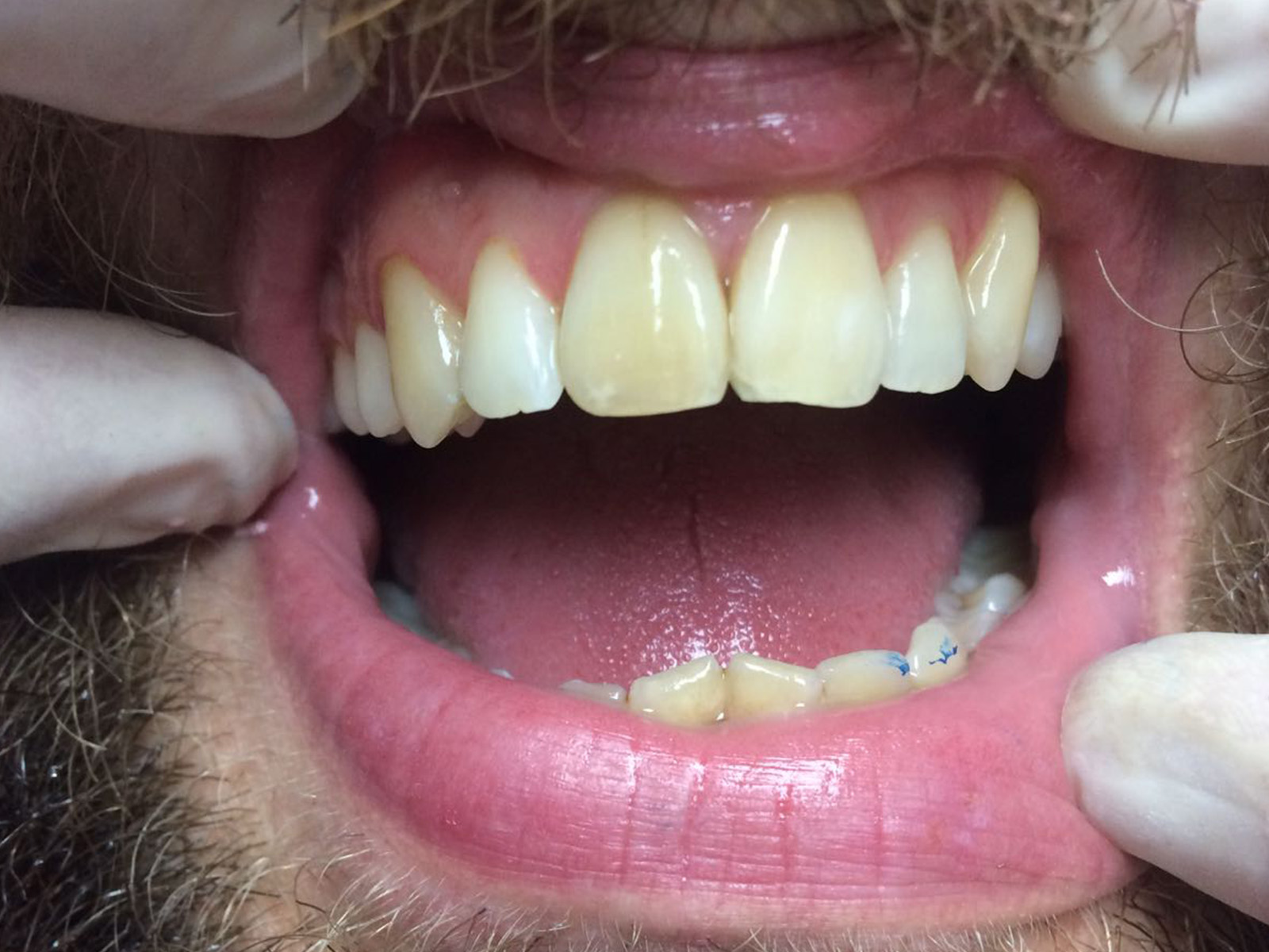 Ortodonzia fissa superiore con attacchi estetici