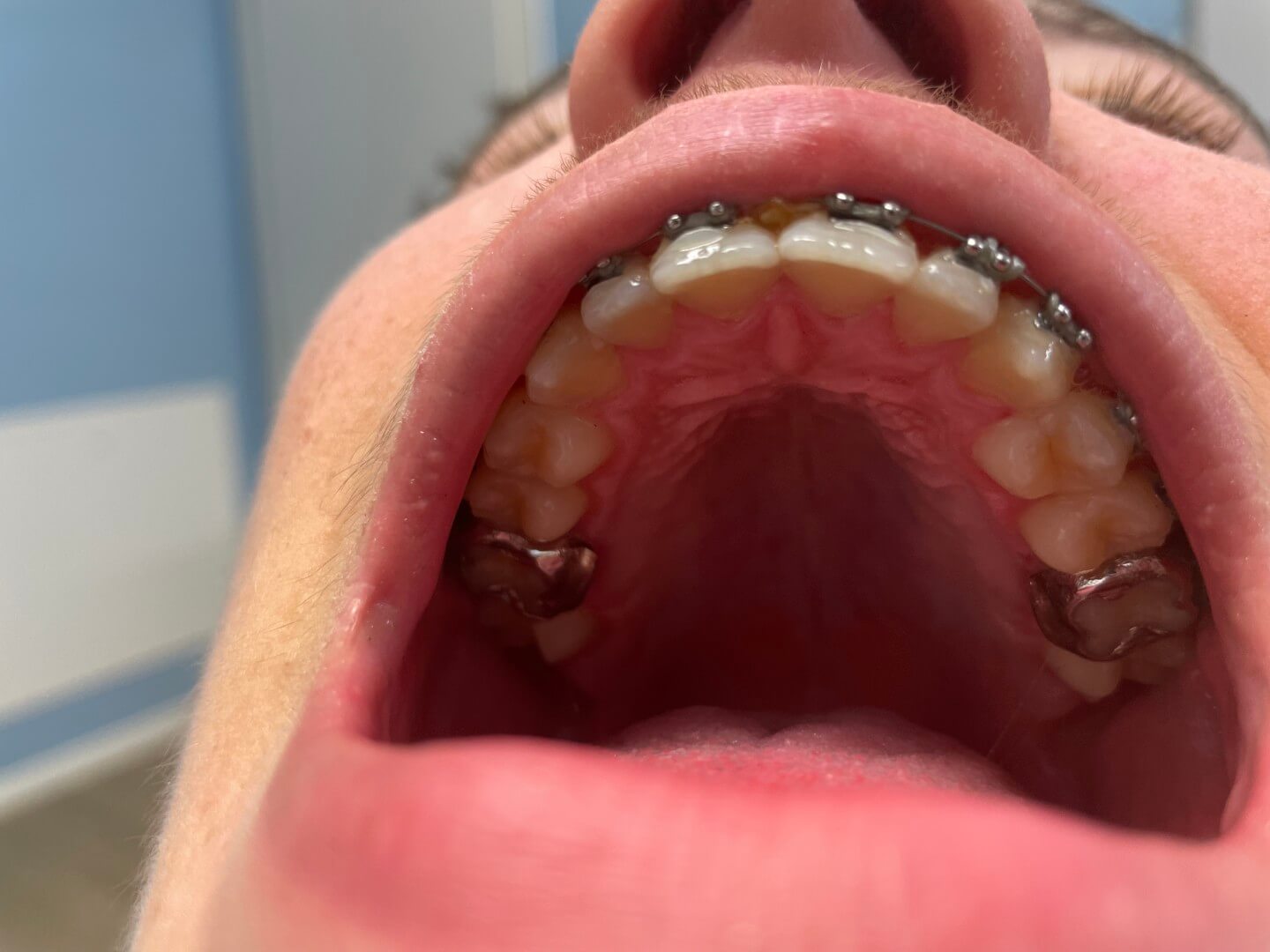Ortodonzia fissa bimascellare con mascherine finali