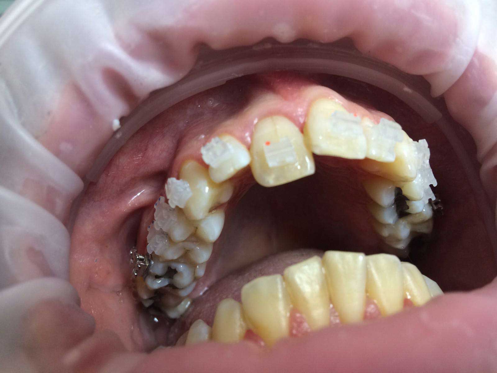 Ortodonzia fissa superiore con attacchi estetici