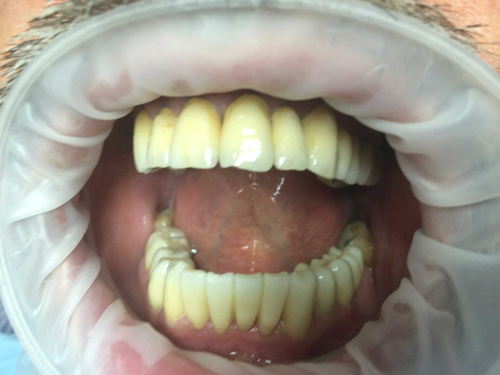 Protesi completa in Zirconio