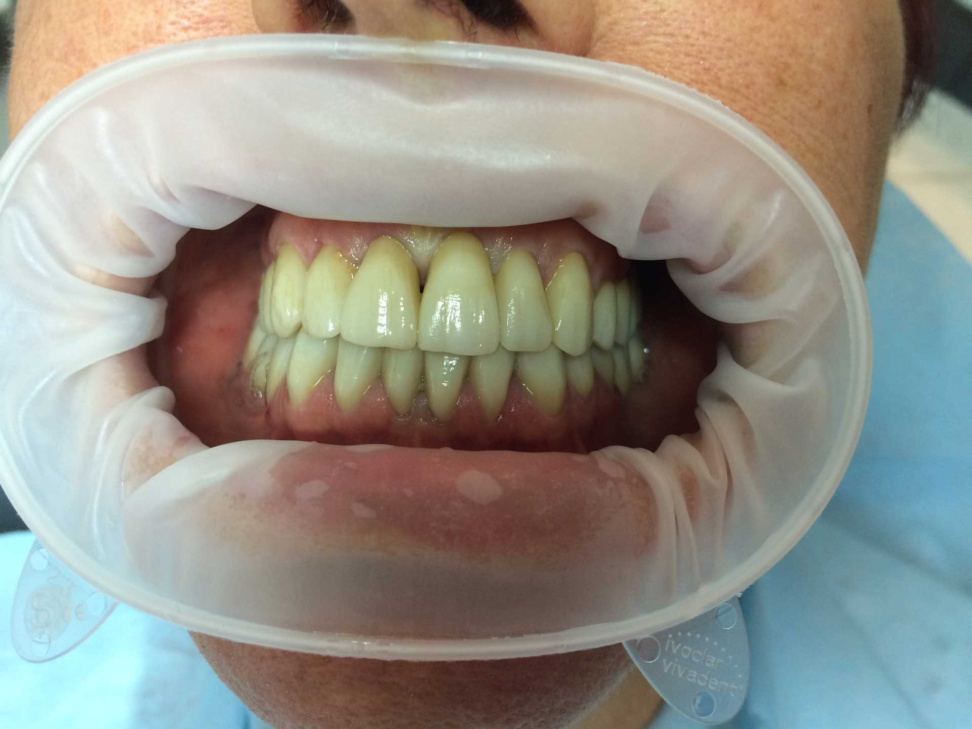 Protesi completa in Zirconio