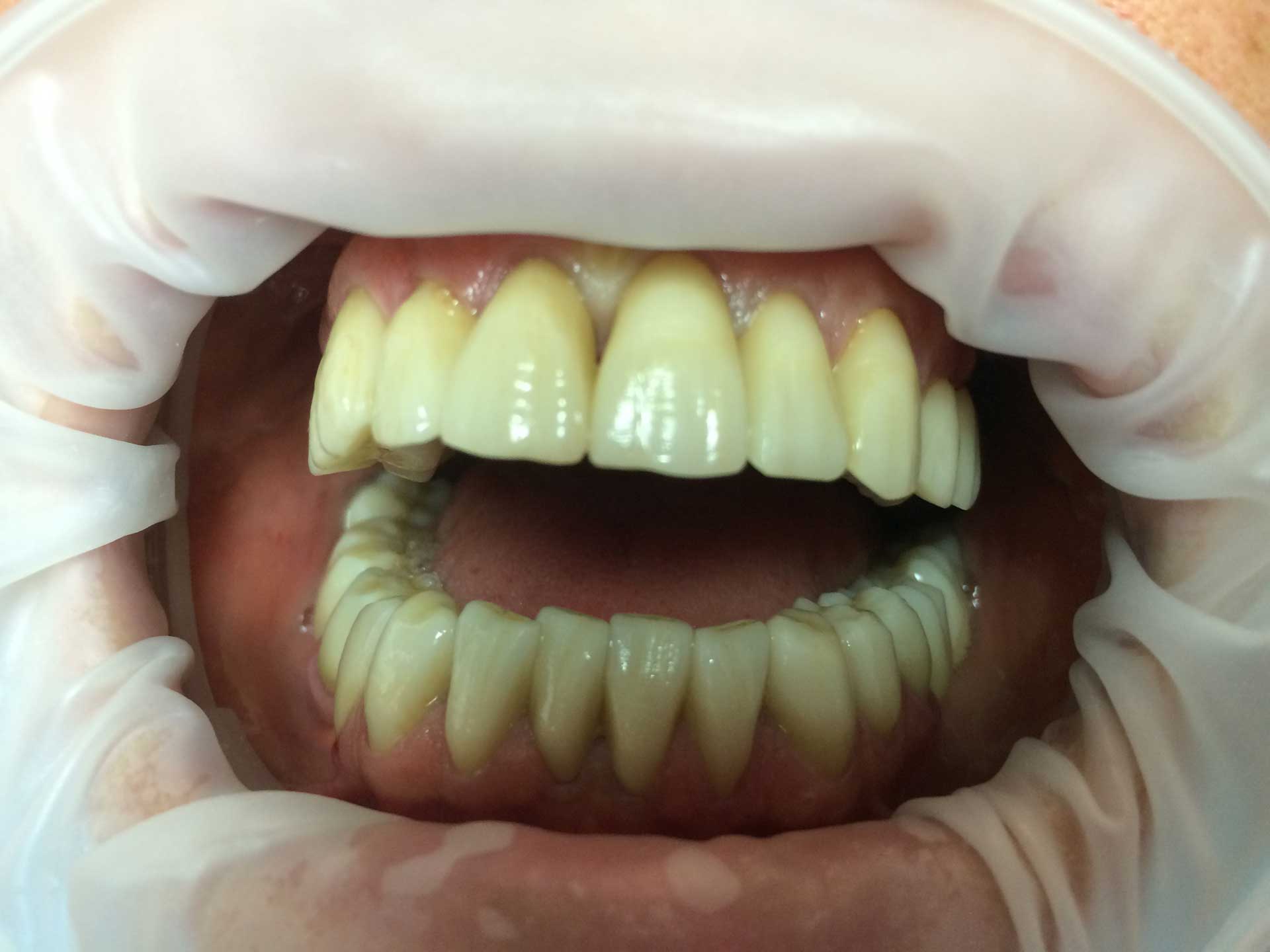 Protesi completa in Zirconio